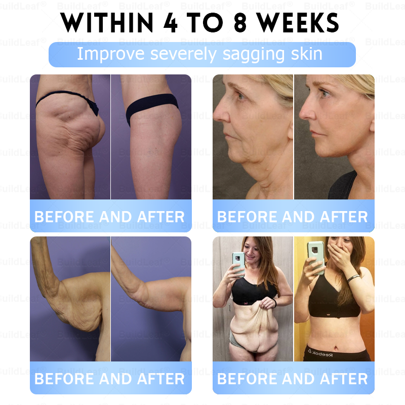 FDA Store·𝐁𝐮𝐢𝐥𝗱𝐋𝐞𝐚𝐟®𝐒𝐥𝐢𝐦 & 𝐅𝐢𝐫𝐦 𝐍𝐚𝐧𝐨 𝐌𝐢𝐜𝐫𝐨𝐧𝐞𝐞𝐝𝐥𝐞 𝐏𝐚𝐭𝐜𝐡 𝐰𝐢𝐭𝐡 𝐌𝐨𝐫𝐢𝐧𝐠𝐚, 𝐎𝐦𝐞𝐠𝐚-𝟑, 𝐂𝐨𝐥𝐥𝐚𝐠𝐞𝐧 𝐏𝐞𝐩𝐭𝐢𝐝𝐞𝐬, 𝐍𝐀𝐃 & 𝐍𝐌𝐍 𝐟𝐨𝐫 𝐎𝐛𝐞𝐬𝐢𝐭𝐲, 𝐂𝐚𝐫𝐝𝐢𝐨𝐯𝐚𝐬𝐜𝐮𝐥𝐚𝐫 𝐃𝐢𝐬𝐞𝐚𝐬𝐞, 𝐃𝐢𝐚𝐛𝐞𝐭𝐞𝐬, 𝐒𝐥𝐞𝐞𝐩 𝐀𝐩𝐧𝐞𝐚, 𝐉𝐨𝐢𝐧𝐭 𝐏𝐫𝐨𝐛𝐥𝐞𝐦𝐬, 𝐒𝐤𝐢𝐧 𝐅𝐢𝐫𝐦𝐢𝐧𝐠, 𝐀𝐧𝐭𝐢-𝐀𝐠𝐢𝐧𝐠, 𝐚𝐧𝐝 𝐌𝐨𝐫𝐞